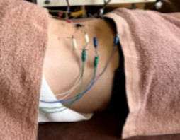 腰痛・ぎっくり腰や自律神経失調症に効く電気鍼