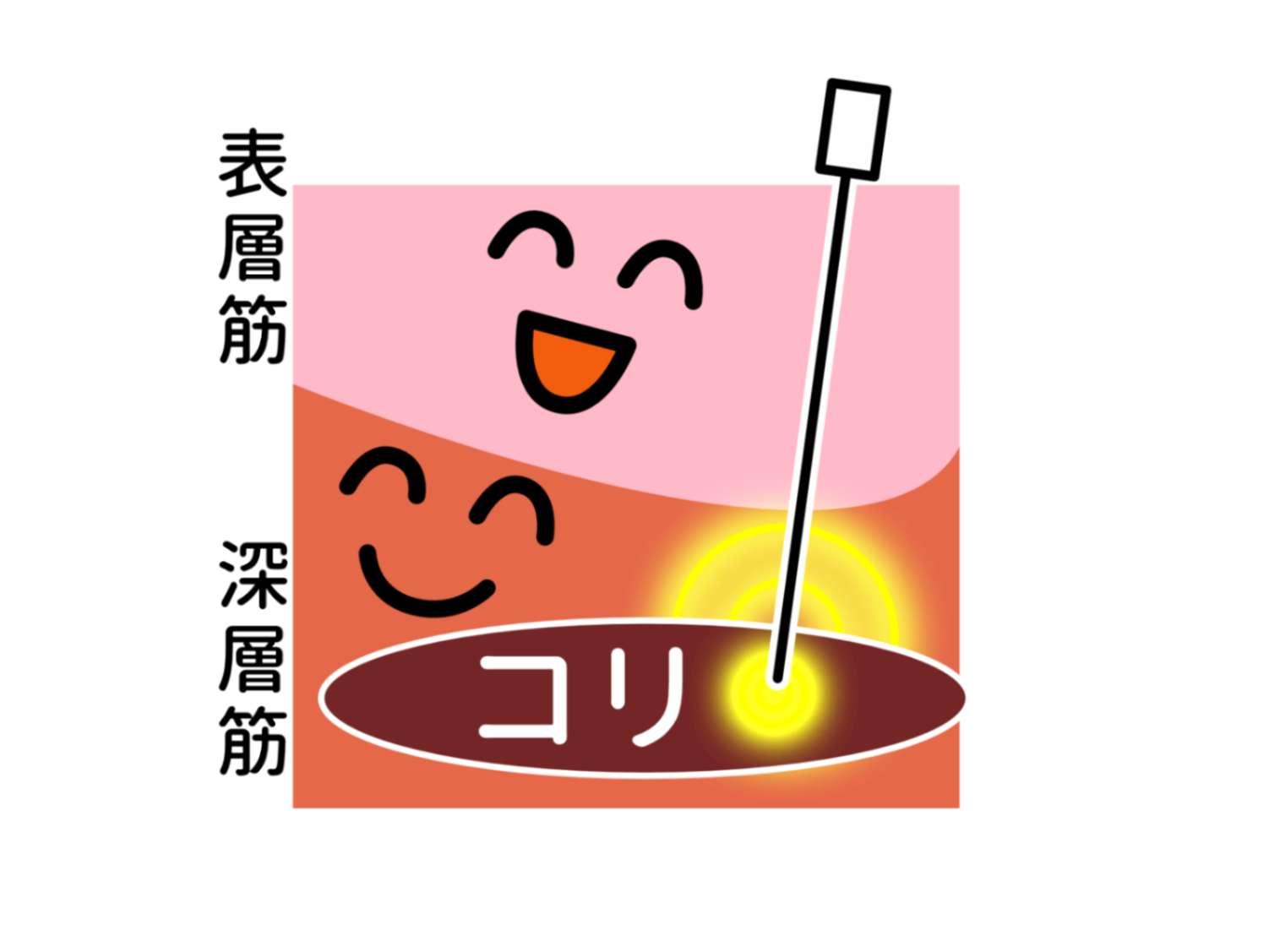 電気鍼で腰痛・ぎっくり腰の痛みをやわらげ、自然治癒力を高める