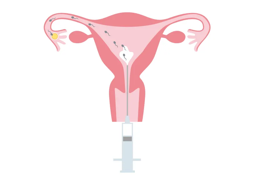 「人工授精」も自然妊娠に近い不妊治療!