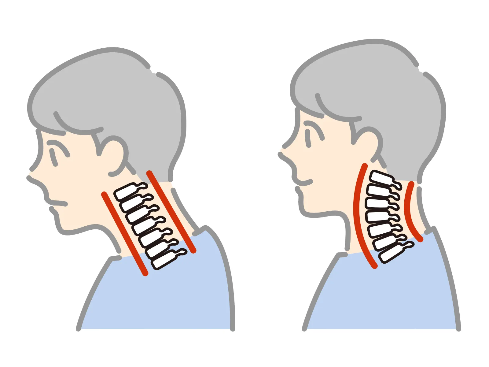 ストレートネックは自然に治る?竹辺鍼灸院の見解